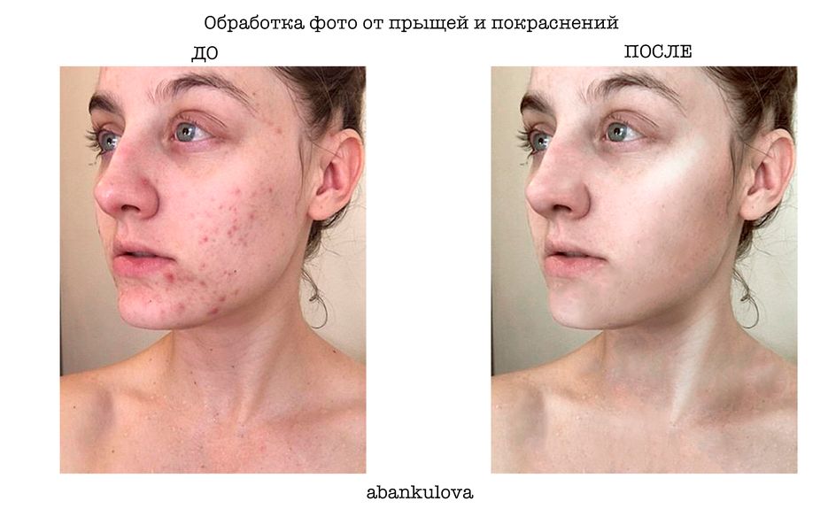 прыщи.png