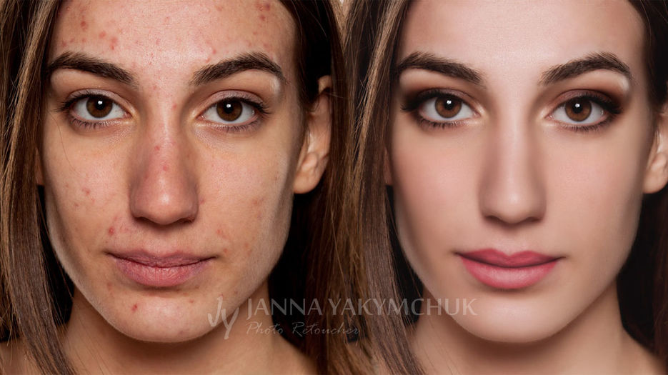 Skin-Retouching-acne.jpg