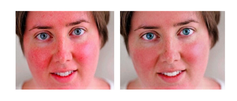redface_two.jpg