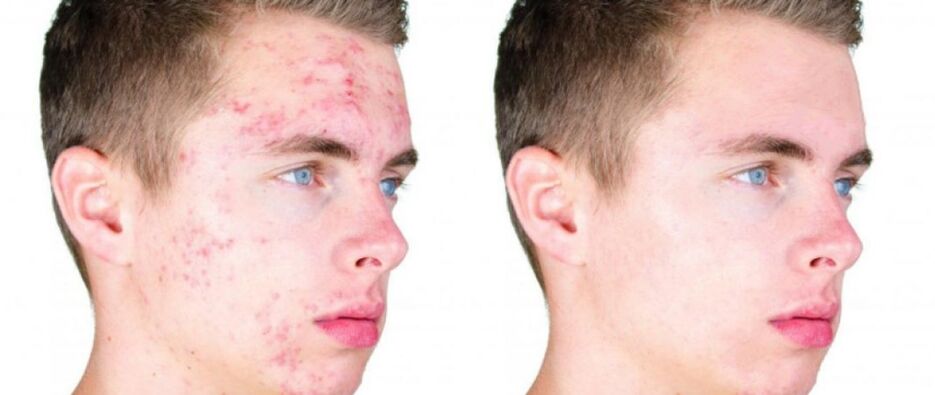 what-is-acne.png