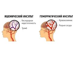 Восстановление речи после инсульта