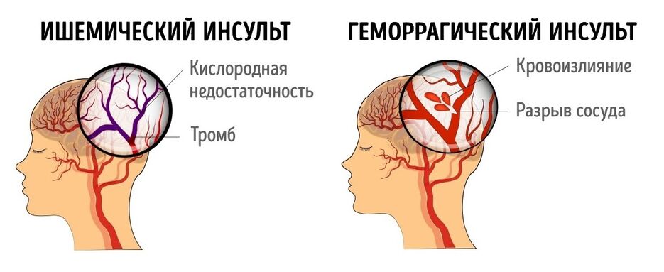 Картинка 2 Виды инсульта1.jpg