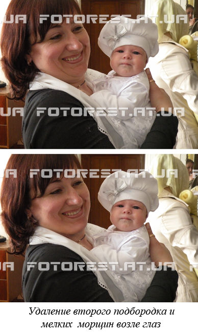 Удаление второго подбородка.jpg